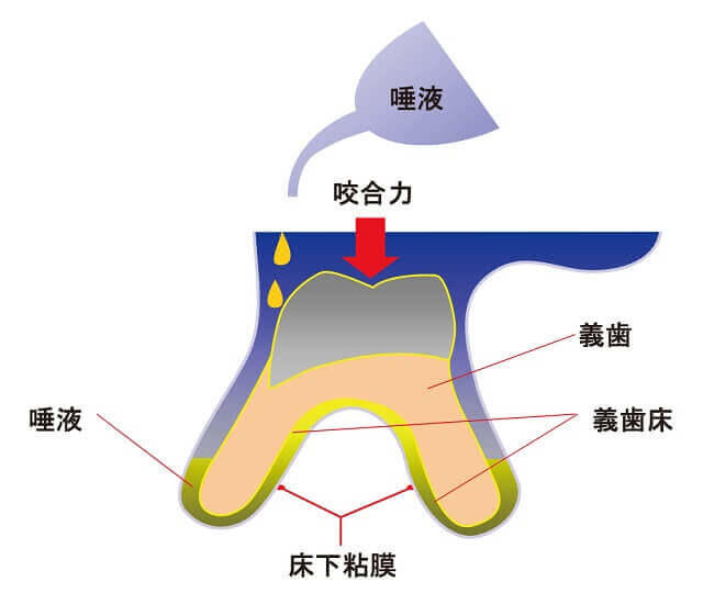 図6：唾液が義歯床の機械的刺激から保護していることを表す模型図