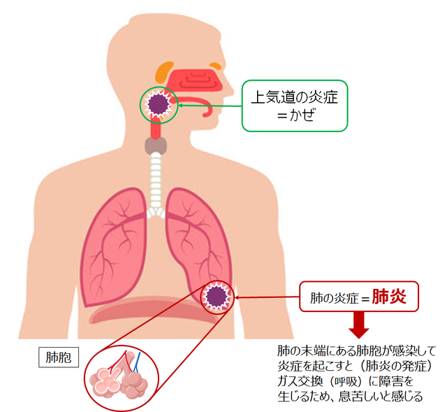 図2：かぜはのどで、肺炎は細胞で細菌やウイルスに感染することを示す図。上気道の絵炎症はかぜ、肺の炎症は肺炎である。肺炎は肺の末端にある肺胞が感染して炎症を起こすとガス交換（呼吸）に障害を生じるため、息苦しいと感じる