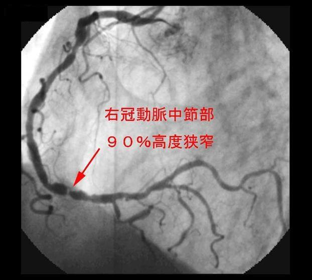 図1: 右冠動脈中節部に90％高度狭窄を示す脳画像