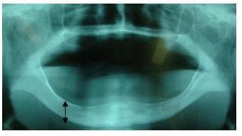 図2：吸収した下顎骨のレントゲン画像。歯肉の盛り上がりが低いことを示す