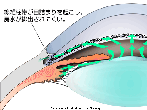 図2：原発開放隅角緑内障を示す図。線維柱帯が目詰まりを起こし、房水が排出されにくいことを示す