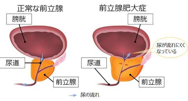 図：正常な前立腺と肥大した前立腺を示した図。肥大した前立腺により尿道が狭くなり、膀胱から尿が流れにくくなっている。