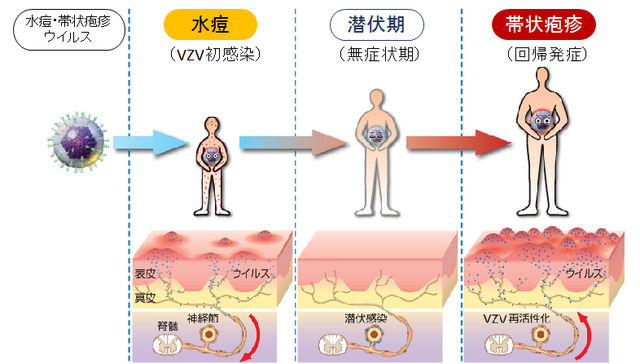 図：帯状疱疹の発症を示す図。水疱瘡ウイルスは水疱瘡にかかった時に、後根神経節に潜伏します。潜伏していたウイルスが活動を活性化することで帯状疱疹を発症する