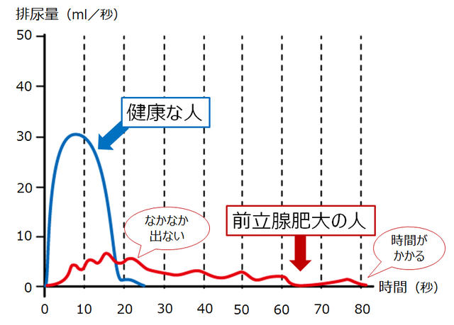 グラフ：健康な人と前立腺肥大症の人の尿流量検査結果の違いを示すグラフ。健康な人は排尿しはじめ10秒で排尿量が30ml/秒に達し、20秒で排尿し終えるのに対し、前立腺肥大症の人は排尿しはじめてから排尿し終えるまでもちょろちょろとしかでず、排尿に80秒程度の時間がかかることが分かる。