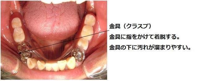 写真:部分入歯(局部義歯)の写真。金具(クラスプ)に指をかけて着脱する。金具の下に汚れが溜まりやすいことを示している。