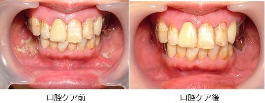 図2:口腔ケア前後の口腔内の様子を示す写真。口腔ケア前は口腔内の歯肉周辺に汚れが溜まっており細菌が増えやすい環境を表す