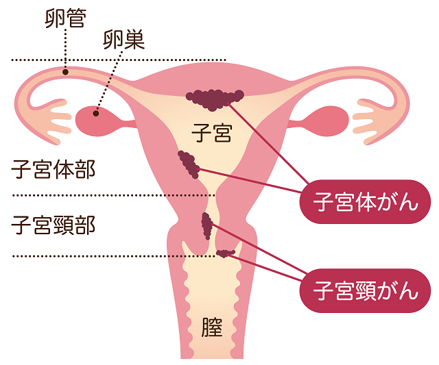 図:子宮癌に分類される子宮の奥の体部に生じる「子宮体がん」と、子宮の入り口付近にできる「子宮頸がん」を示す図。