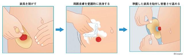 図4:装具を剥がす、周囲皮膚を愛護的に洗浄する、準備した装具を貼付し密着させ温めるというストーマ装具の交換手順を示す図。