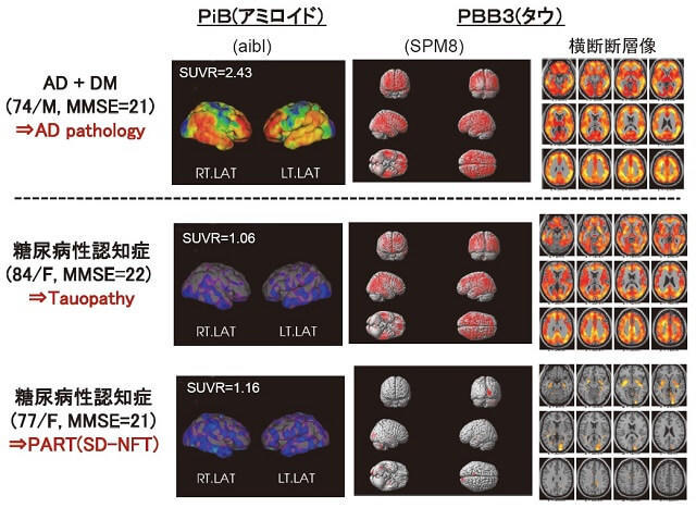 図2：糖尿病を伴うADと糖尿病性認知症のアミロイド、タウPETの状態をあらわす脳画像。