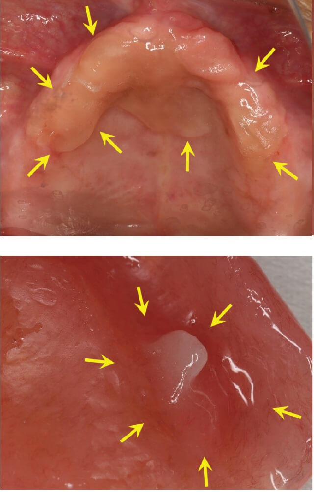 図2：義歯床下粘膜、義歯粘膜面に残留した義歯粘着剤を写した2枚の写真
