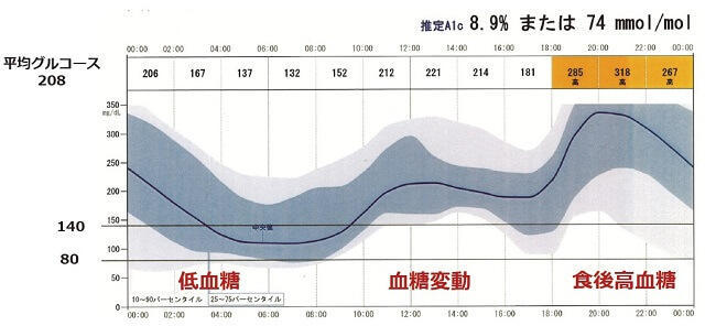 図3：FreeStyle LibreProによる糖尿病性認知症の持続血糖測定を示す図。食後高血糖、早朝時に低血糖がみられる。