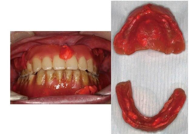 図3：義歯粘膜面から研磨面に溢れ出ている写真と義歯粘膜面不均一にホームリライナーが付着している全部床義歯の粘膜面の写真の2枚の写真