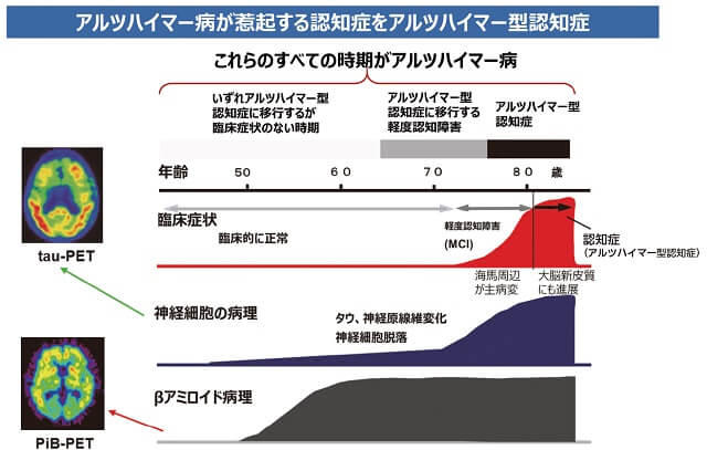 図4：アルツハイマー病とアルツハイマー型認知症の違いを示す図。