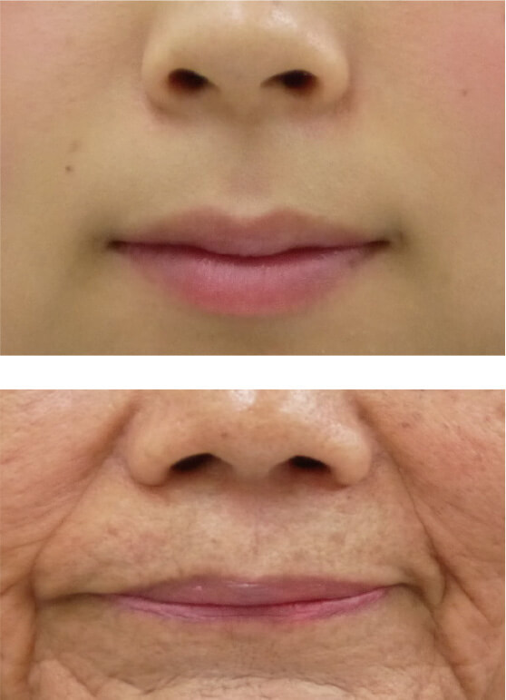 図４：20代女性と70代女性の口周辺の加齢変化を示す写真。