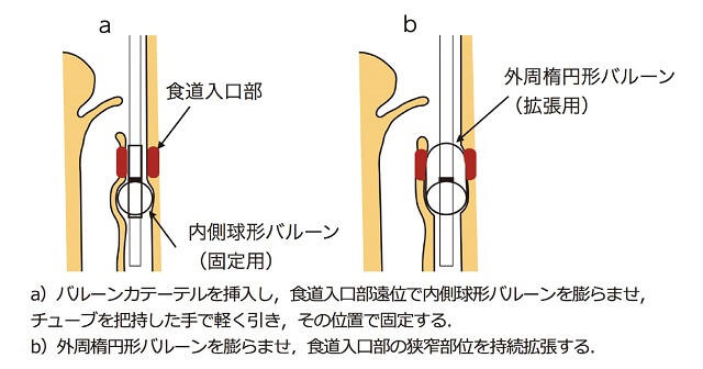 図4：クリエートメディック株式会社製の食道拡張用バルーンカテーテルを食道入口で装着する際の様子を表した図
