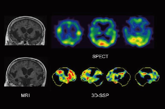 図1：特発性正常圧水頭症にADを合併していると考えられた症例をあらわす脳画像