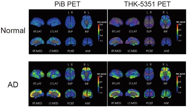認知機能正常者とアルツハイマー病患者におけるβアミロイドPETおよびタウPETの脳表面プロジェクションをあらわした脳画像