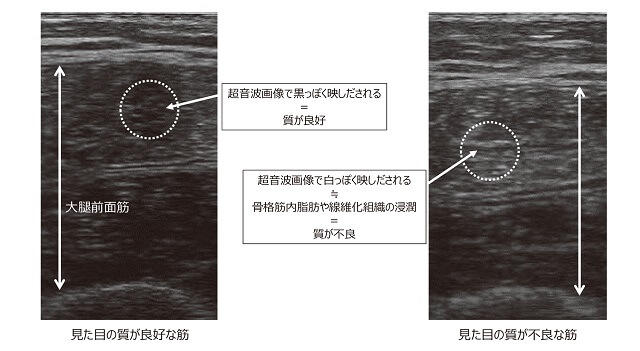 図6：骨格筋の質を見た目で評価する方法を表す図。