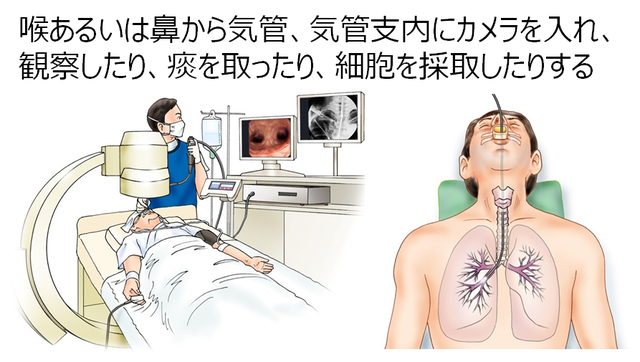 図1：気管支鏡検査のイメージ図。喉あるいは鼻から気管、気管支内にカメラを入れ、観察したり、痰を取ったり、細胞を採取したりする。