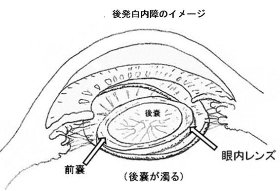 図5：後発白内障のイメージ図。