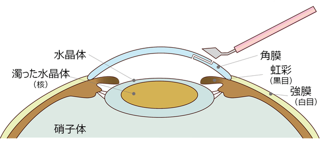 図2：眼内の水晶体嚢を示す図