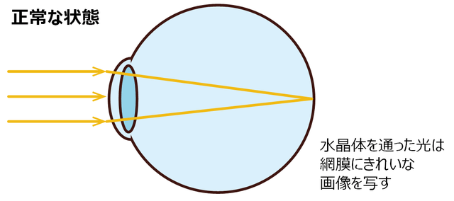 図2：正常な水晶体の場合、水晶体を通った光は目の奥にある網膜にピントを合わせ、きれいな画像を写すことが出来きることを示す図。