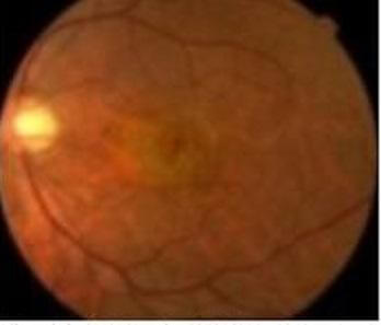 図2:加齢黄斑変性(萎縮型)の眼底画像