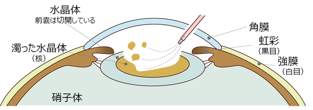 図3：超音波乳化吸引器の使用イメージ図