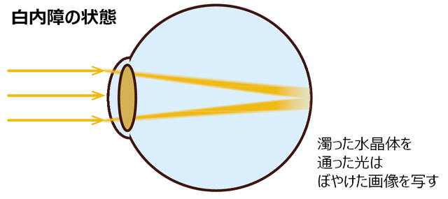 図3：白内障の模式図。濁った水晶体に光を通すため、焦点がぼやけた画像を写す状態を示す