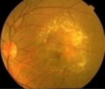 図3：加齢黄斑変性（滲出型）の眼底画像