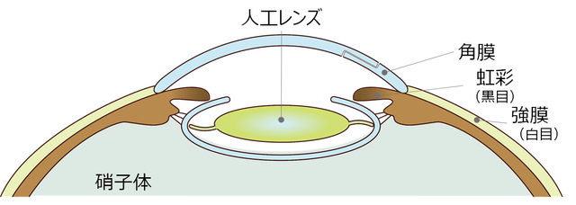 図4：取り除いた水晶体の代わりに人工水晶体を入れたイメージ図