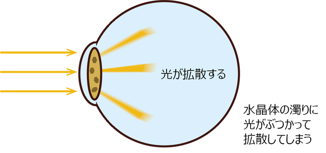 図4：白内障による光の散乱を示す図。水晶体の濁りが瞳の部分に重なった場合、極端にまぶしく感じたり、明るい光を見ると像がとらえにくくなっていることを表している