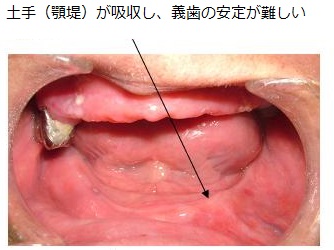 図1：吸収した下顎の顎堤の写真。本来土手状に盛り上がっている顎堤が吸収され、義歯の安定が難しいことを表す