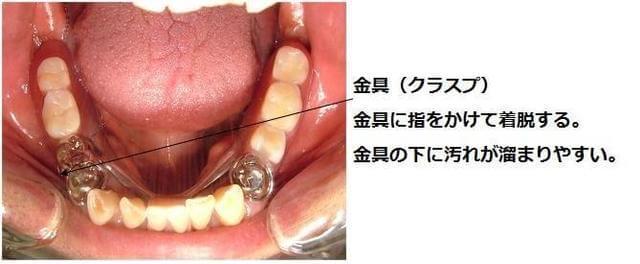 写真：部分入歯（局部義歯）の写真。金具（クラスプ）に指をかけて着脱する。金具の下に汚れが溜まりやすいことを示している。