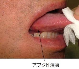 図1：アフタ性潰瘍（口内炎）を示す写真。舌の側面に小円型の潰瘍が見られる