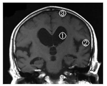 図1：特発性正常圧水頭症のMRI画像