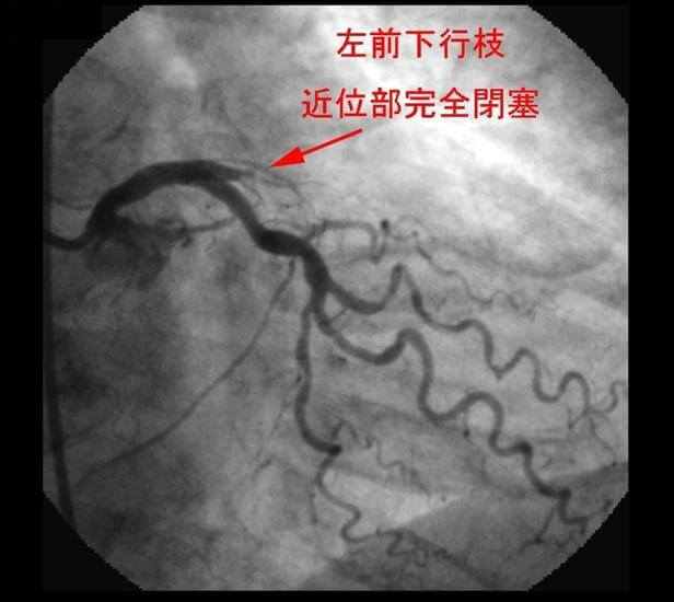 図1：左前下行枝近位部で閉塞していることを示す例の造影写真