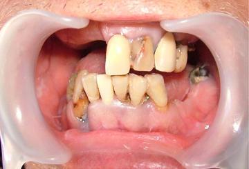 写真1：重症歯周病患者の口腔状態を示す写真。歯肉に炎症がみられ腫れており、奥歯が抜けていることを示している