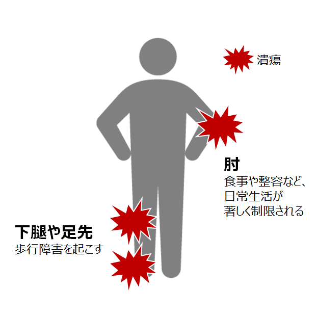 図１：皮膚潰瘍の好発部位と障害を示した図。肘に潰瘍ができると食事や整容など、日常生活が著しく制限される。また、下腿や足先に潰瘍ができると歩行障害を起こす。