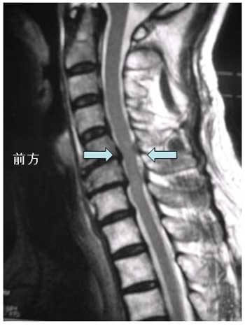図2：頚椎の前方からの椎間板および後方からの靭帯により神経が圧迫を受けていることをしめす脊髄症のレントゲン写真