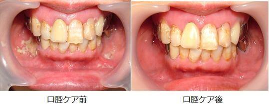 図2：口腔ケア前後の口腔内の様子を示す写真。口腔ケア前は口腔内の歯肉周辺に汚れが溜まっており細菌が増えやすい環境を表す