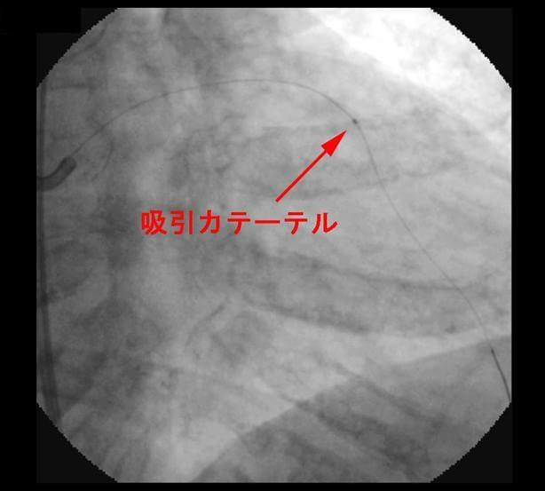 図2:ガイドワイヤー挿入後、血栓吸引を示す例の造影写真