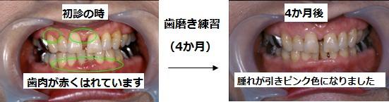 写真2:4か月の歯磨き練習の歯肉の変化 を示す写真。練習前は歯肉が赤くはれ上がっていたが、4か月の歯磨き練習後は歯肉の腫れが引いてピンク色になっていることを表す