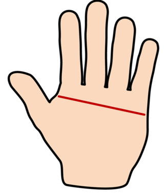 図2: 手掌単一屈曲線を示す手のひらのイラスト。