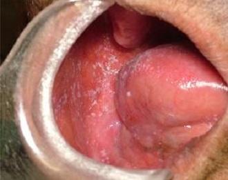 図3：口腔カンジダ症を示す写真。ほほの粘膜にカビの一種カンジダが発生している