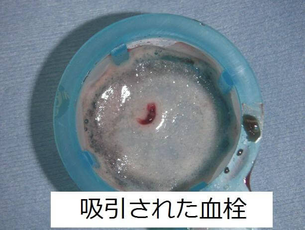 図3:吸引された冠動脈内血栓の写真