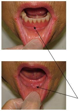 図4：義歯性潰瘍を示す写真。義歯を取り外すと下顎堤に口内炎ができていることを示す