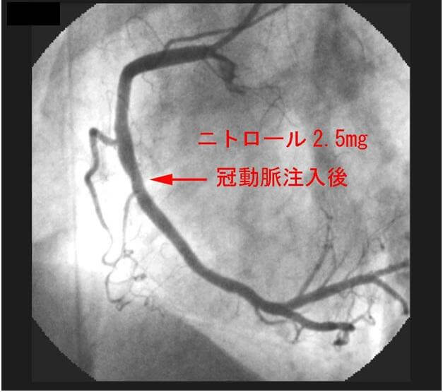 図4：ニトロール2.5mg冠動脈注入後、スパスムは消失を示す例の脳画像