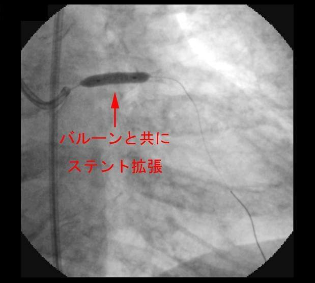 図４：左前下行枝近位部にステントで閉塞血管拡張を示す例の造影写真