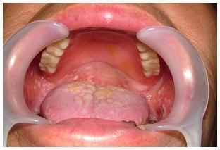 図5：寝たきりで清掃状態が悪く、口腔内にカンジダ菌発生していることを示す写真